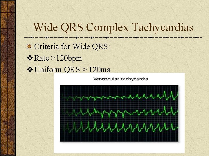Wide QRS Complex Tachycardias Criteria for Wide QRS: v Rate >120 bpm v Uniform