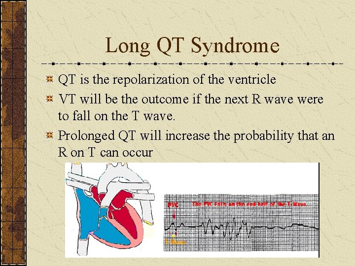 Long QT Syndrome QT is the repolarization of the ventricle VT will be the