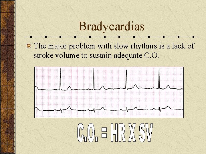 Bradycardias The major problem with slow rhythms is a lack of stroke volume to