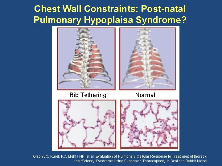 Chest Wall Constraints: Post-natal Pulmonary Hypoplaisa Syndrome? Rib Tethering Normal Olson JC, Kurek KC,