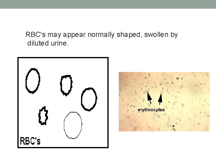 RBC's may appear normally shaped, swollen by diluted urine. 