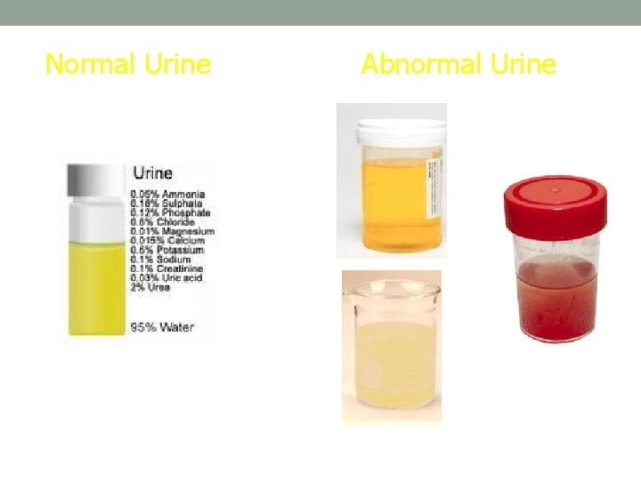 Normal Urine Abnormal Urine 