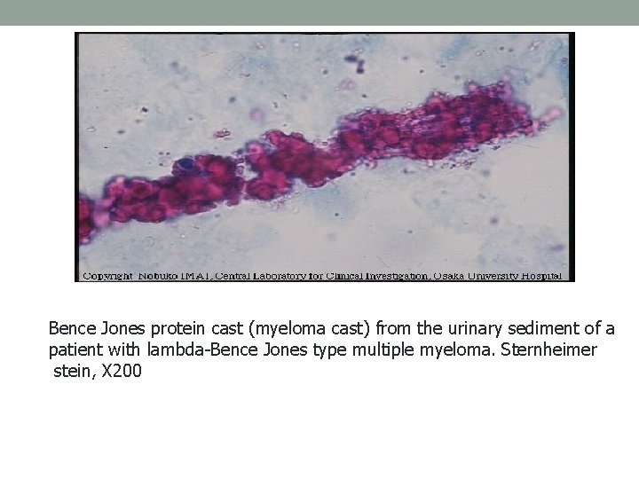 Bence Jones protein cast (myeloma cast) from the urinary sediment of a patient with