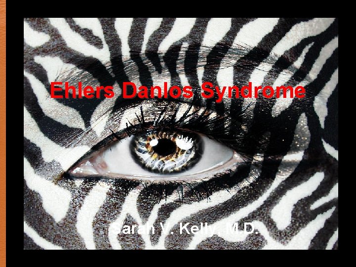 Ehlers Danlos Syndrome Sarah V. Kelly, M. D. 