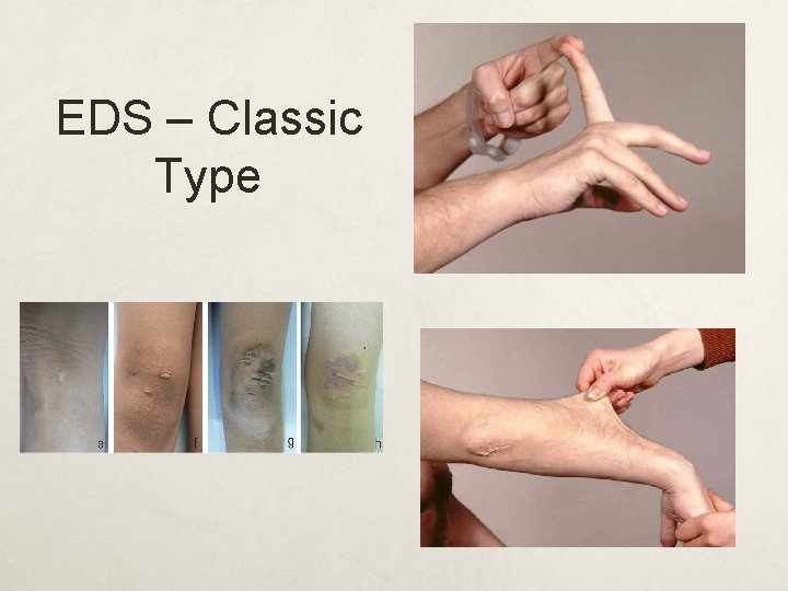 EDS – Classic Type 