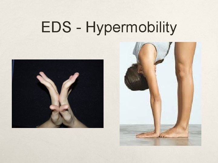 EDS - Hypermobility 