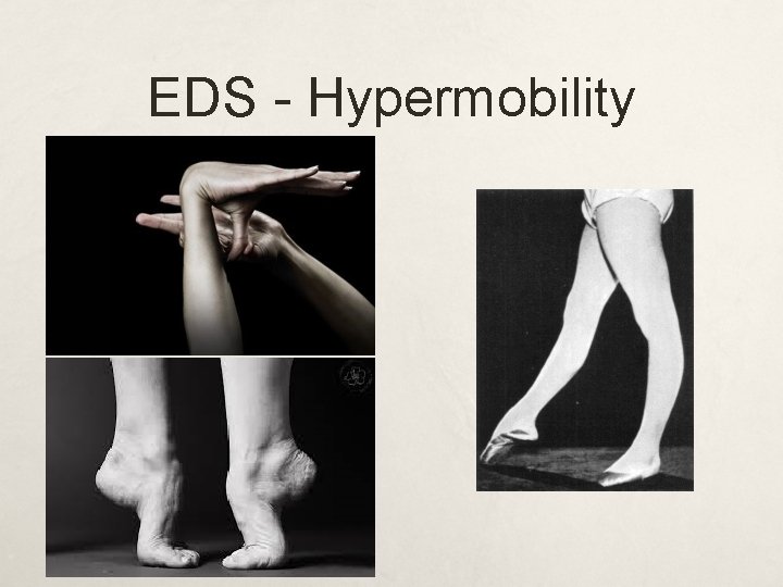 EDS - Hypermobility 