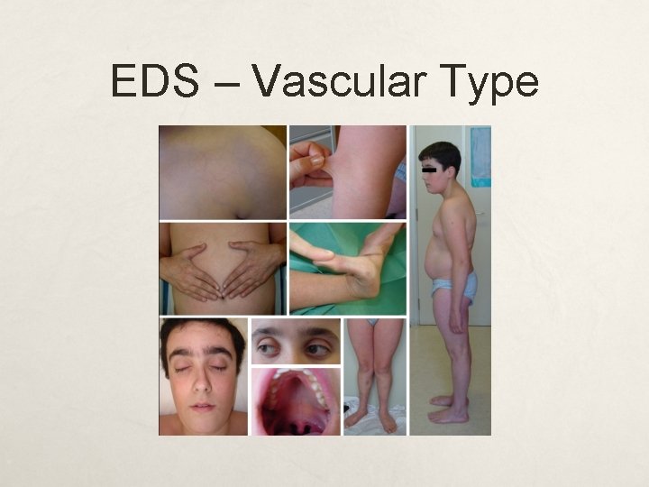 EDS – Vascular Type 