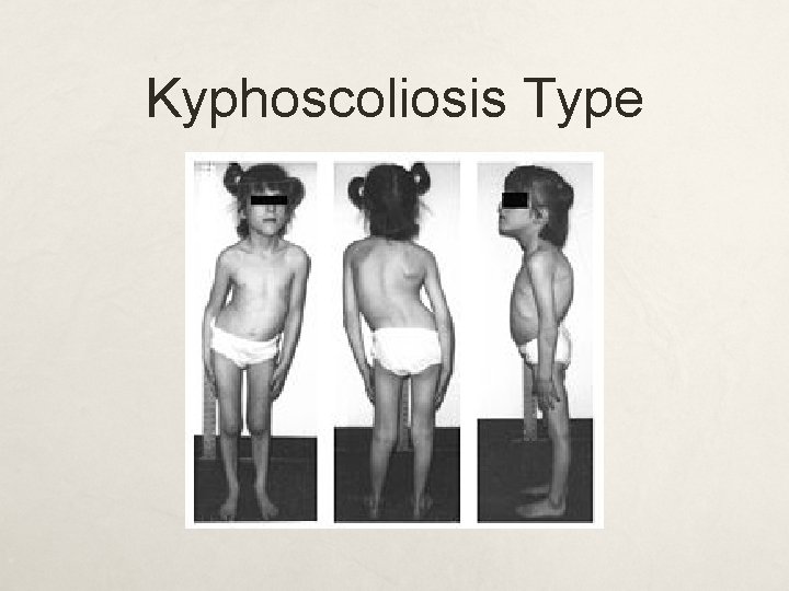 Kyphoscoliosis Type 