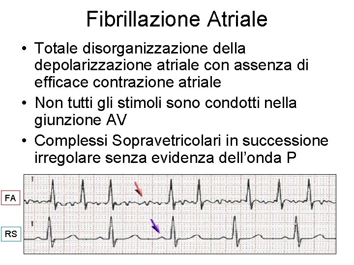 Fibrillazione Atriale • Totale disorganizzazione della depolarizzazione atriale con assenza di efficace contrazione atriale