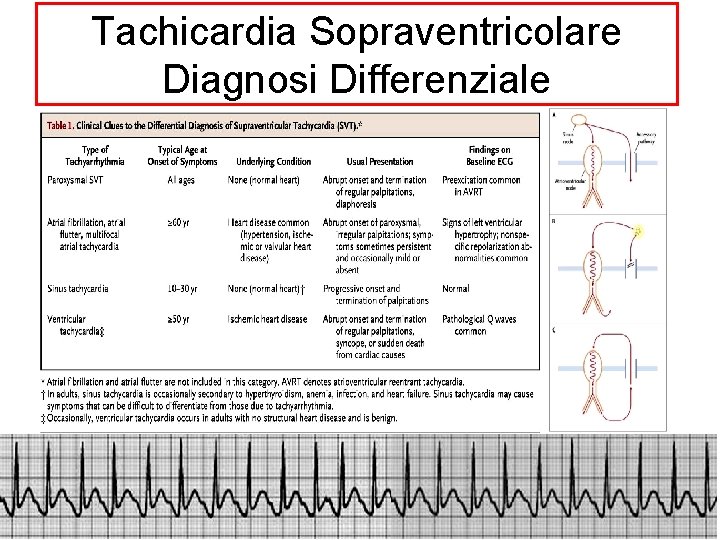 Tachicardia Sopraventricolare Diagnosi Differenziale 