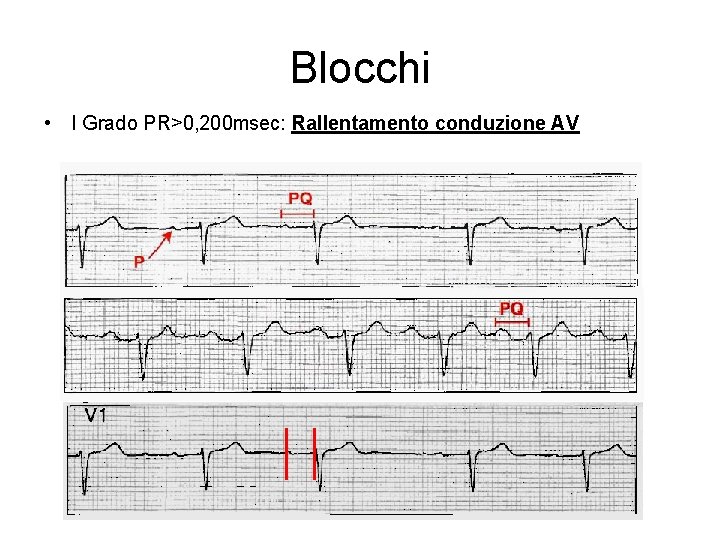 Blocchi • I Grado PR>0, 200 msec: Rallentamento conduzione AV 