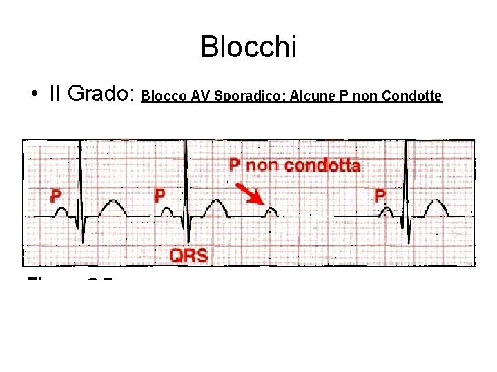 Blocchi • II Grado: Blocco AV Sporadico; Alcune P non Condotte 