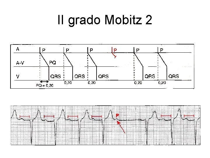 II grado Mobitz 2 