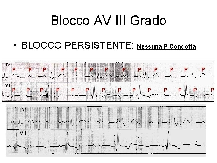 Blocco AV III Grado • BLOCCO PERSISTENTE: Nessuna P Condotta 