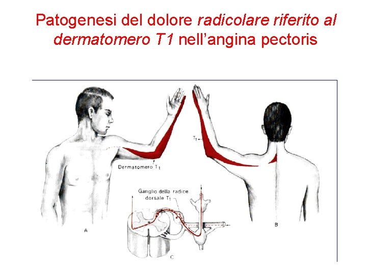 Patogenesi del dolore radicolare riferito al dermatomero T 1 nell’angina pectoris 