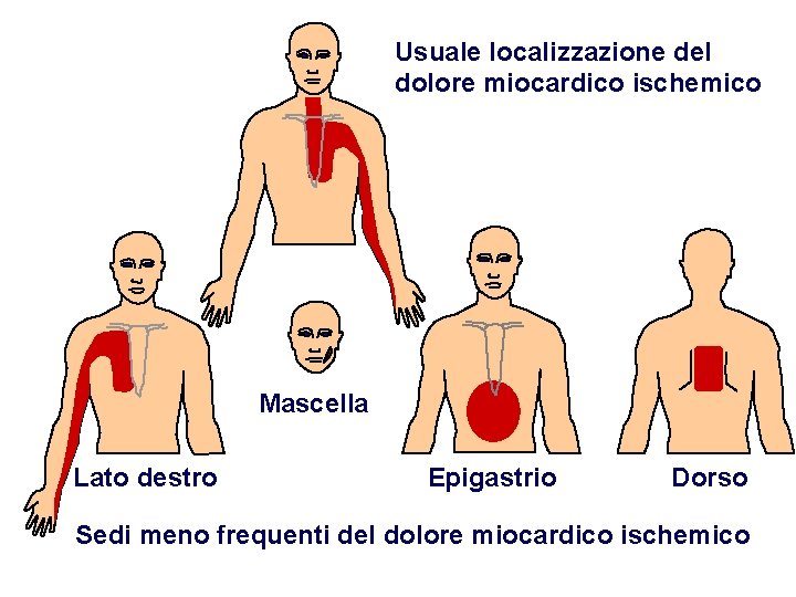 Usuale localizzazione del dolore miocardico ischemico Mascella Lato destro Epigastrio Dorso Sedi meno frequenti