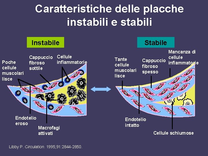 Caratteristiche delle placche instabili e stabili Instabile Poche cellule muscolari lisce Cappuccio Cellule infiammatorie