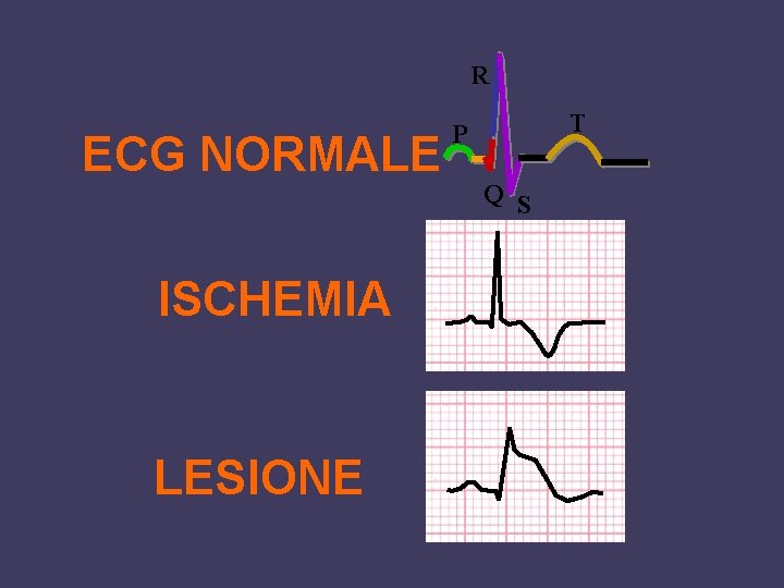 R ECG NORMALE ISCHEMIA LESIONE T P Q S 