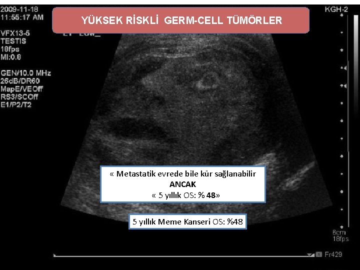 YÜKSEK RİSKLİ GERM-CELL TÜMÖRLER « Metastatik evrede bile kür sağlanabilir ANCAK « 5 yıllık