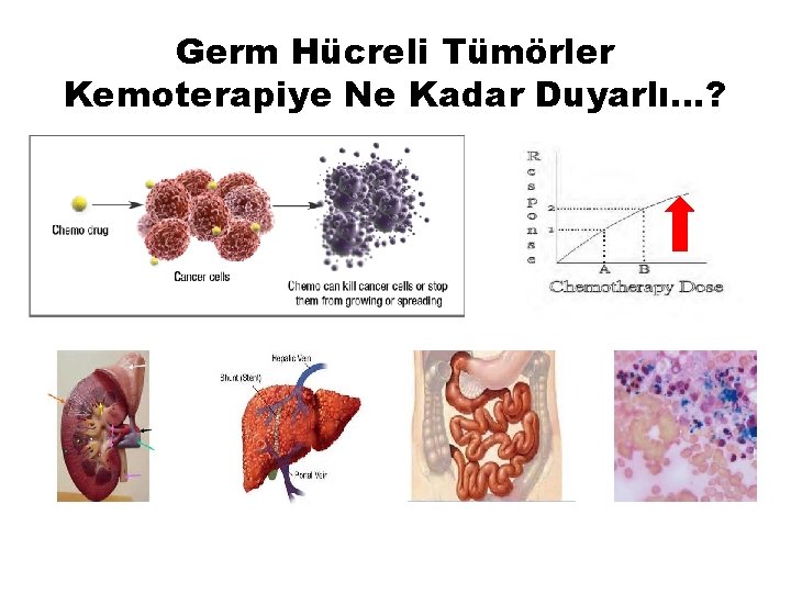 Germ Hücreli Tümörler Kemoterapiye Ne Kadar Duyarlı…? 