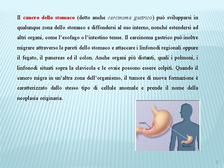 Il cancro dello stomaco (detto anche carcinoma gastrico) può svilupparsi in qualunque zona dello