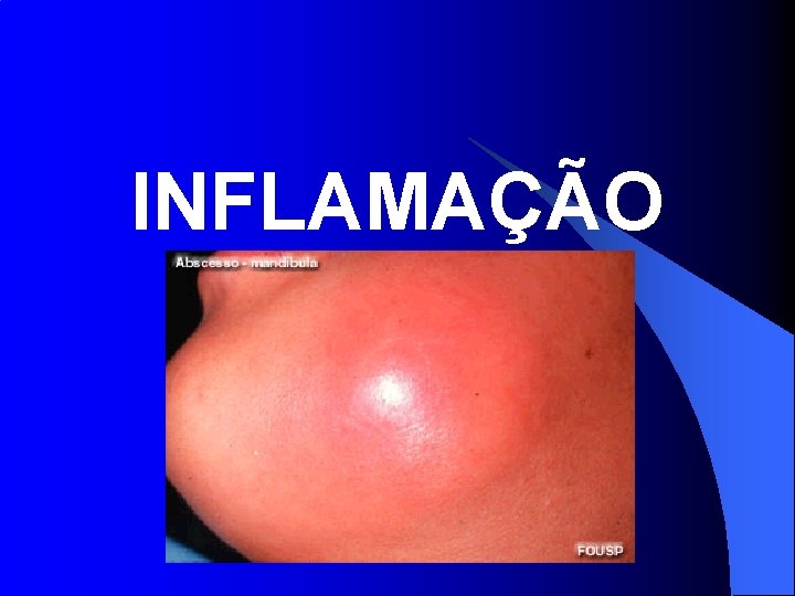 INFLAMAÇÃO 