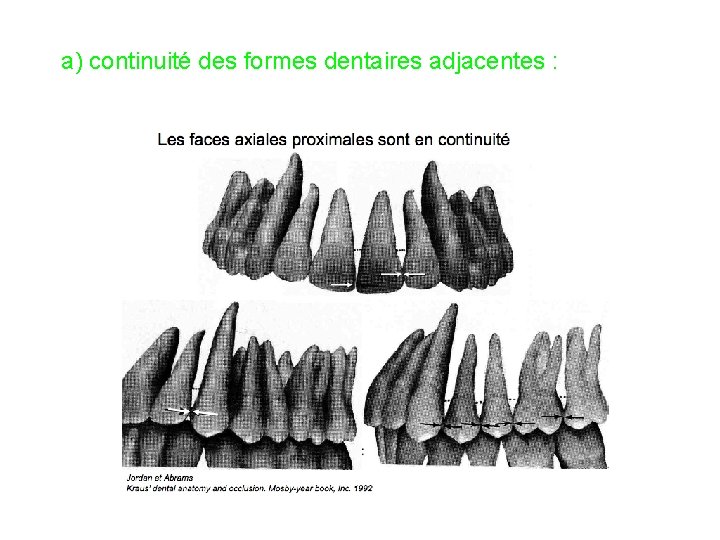 a) continuité des formes dentaires adjacentes : 