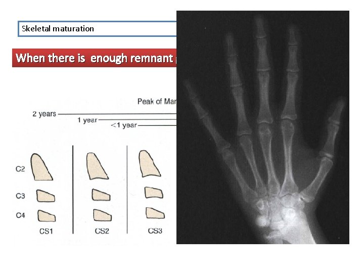 Skeletal maturation When there is enough remnant growth? 