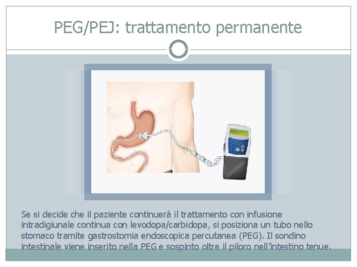 PEG/PEJ: trattamento permanente Se si decide che il paziente continuerà il trattamento con infusione