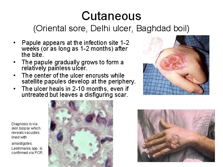 Cutaneous (Oriental sore, Delhi ulcer, Baghdad boil) • Papule appears at the infection site