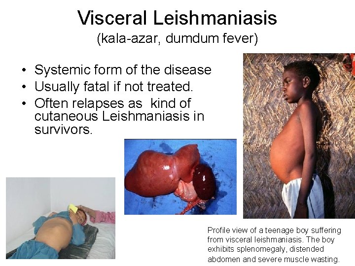 Visceral Leishmaniasis (kala-azar, dumdum fever) • Systemic form of the disease • Usually fatal