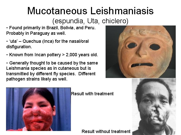 Mucotaneous Leishmaniasis (espundia, Uta, chiclero) • Found primarily in Brazil, Bolivia, and Peru. Probably