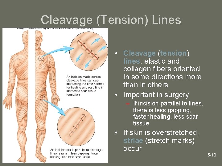 Cleavage (Tension) Lines • Cleavage (tension) lines: elastic and collagen fibers oriented in some