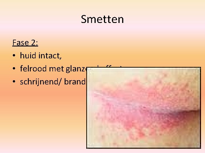 Smetten Fase 2: • huid intact, • felrood met glanzend effect, • schrijnend/ branderig.