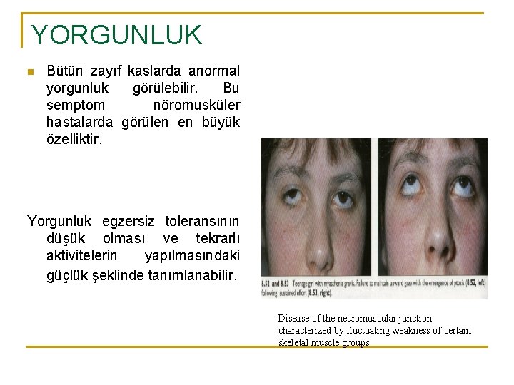 YORGUNLUK n Bütün zayıf kaslarda anormal yorgunluk görülebilir. Bu semptom nöromusküler hastalarda görülen en