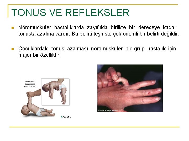 TONUS VE REFLEKSLER n Nöromusküler hastalıklarda zayıflıkla birlikte bir dereceye kadar tonusta azalma vardır.