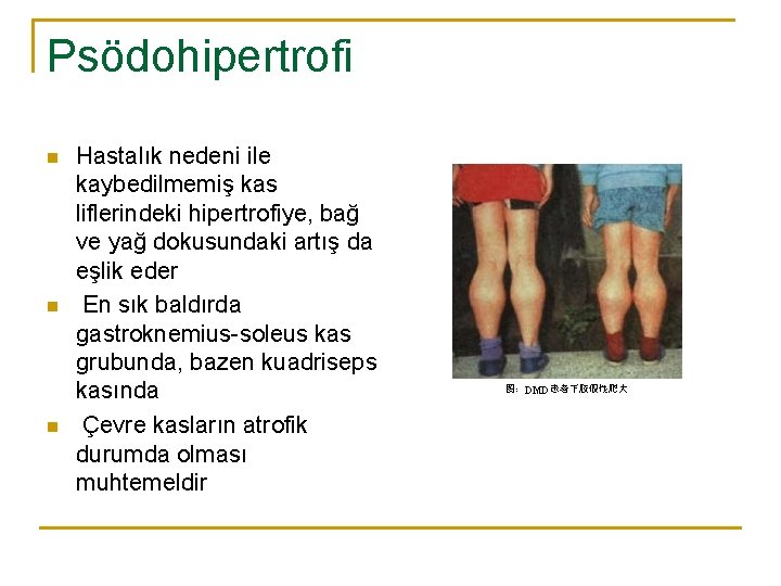 Psödohipertrofi n n n Hastalık nedeni ile kaybedilmemiş kas liflerindeki hipertrofiye, bağ ve yağ