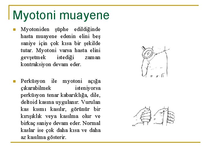 Myotoni muayene n Myotoniden şüphe edildiğinde hasta muayene edenin elini beş saniye için çok