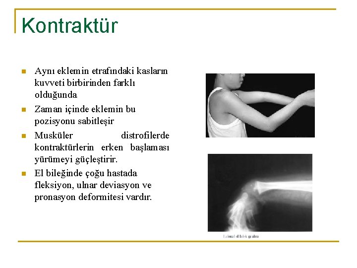 Kontraktür n n Aynı eklemin etrafındaki kasların kuvveti birbirinden farklı olduğunda Zaman içinde eklemin