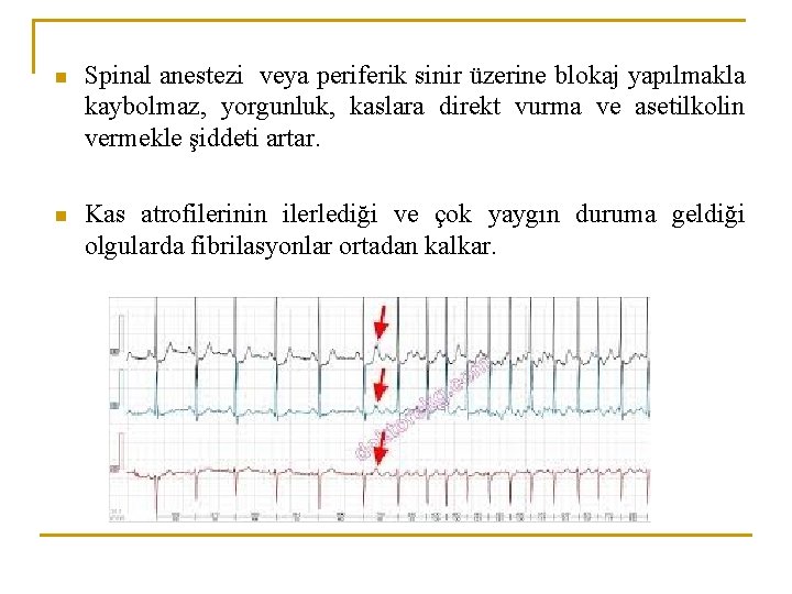 n Spinal anestezi veya periferik sinir üzerine blokaj yapılmakla kaybolmaz, yorgunluk, kaslara direkt vurma