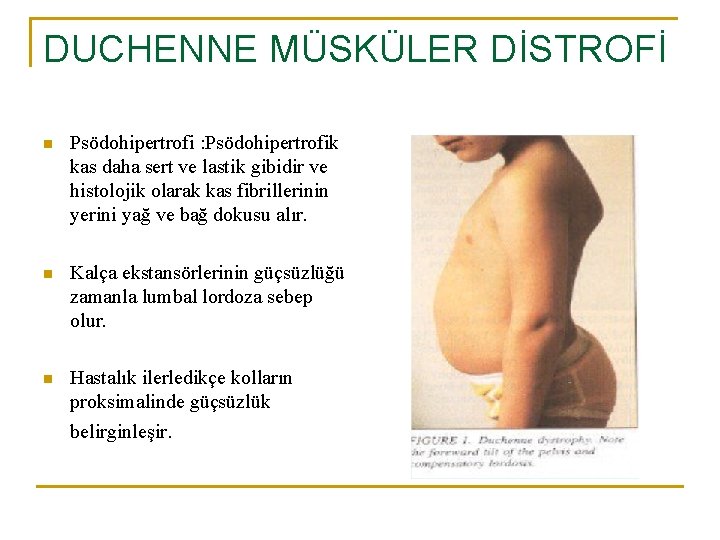 DUCHENNE MÜSKÜLER DİSTROFİ n Psödohipertrofi : Psödohipertrofik kas daha sert ve lastik gibidir ve