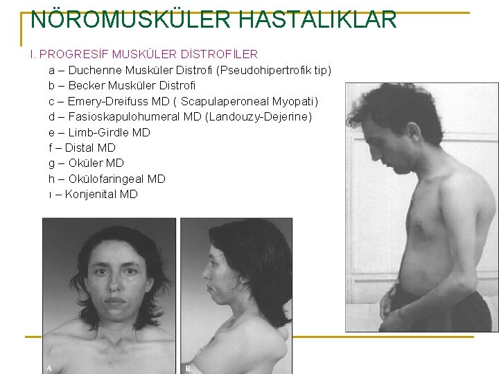 NÖROMUSKÜLER HASTALIKLAR I. PROGRESİF MUSKÜLER DİSTROFİLER a – Duchenne Musküler Distrofi (Pseudohipertrofik tip) b