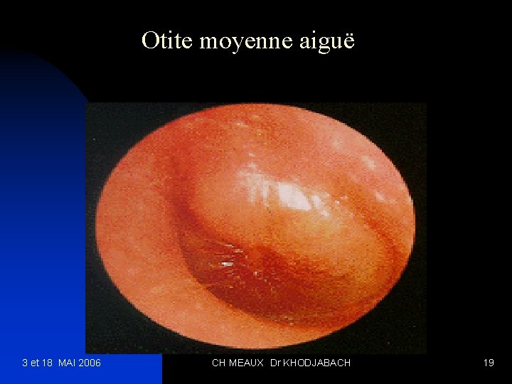 Otite moyenne aiguë 3 et 18 MAI 2006 CH MEAUX Dr KHODJABACH 19 