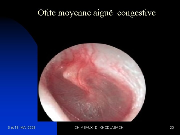 Otite moyenne aiguë congestive 3 et 18 MAI 2006 CH MEAUX Dr KHODJABACH 20