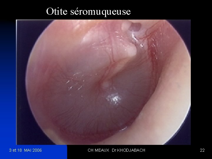 Otite séromuqueuse 3 et 18 MAI 2006 CH MEAUX Dr KHODJABACH 22 