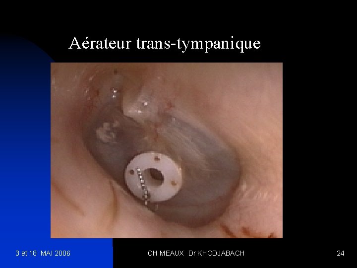 Aérateur trans-tympanique 3 et 18 MAI 2006 CH MEAUX Dr KHODJABACH 24 