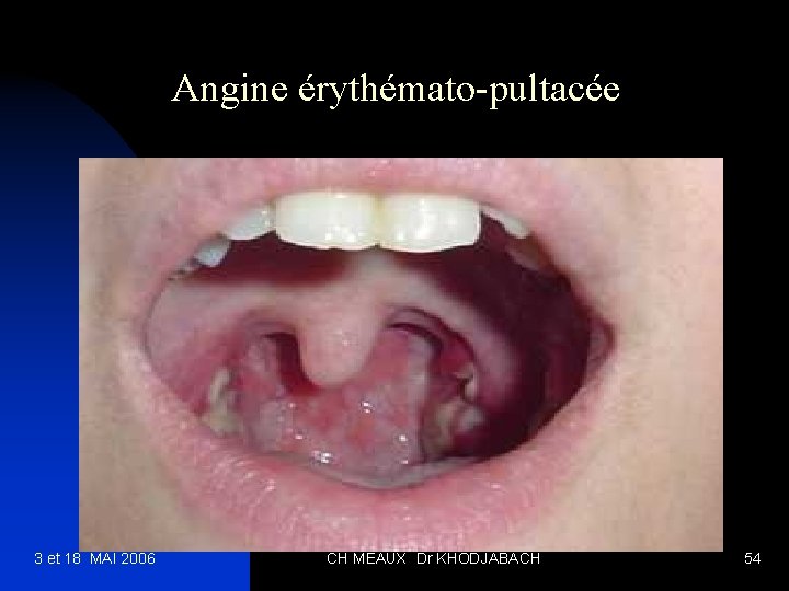 Angine érythémato-pultacée 3 et 18 MAI 2006 CH MEAUX Dr KHODJABACH 54 