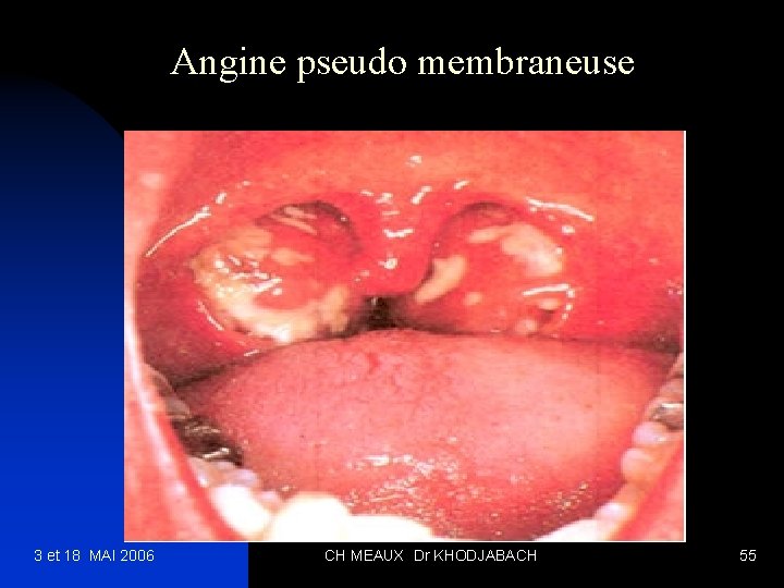 Angine pseudo membraneuse 3 et 18 MAI 2006 CH MEAUX Dr KHODJABACH 55 