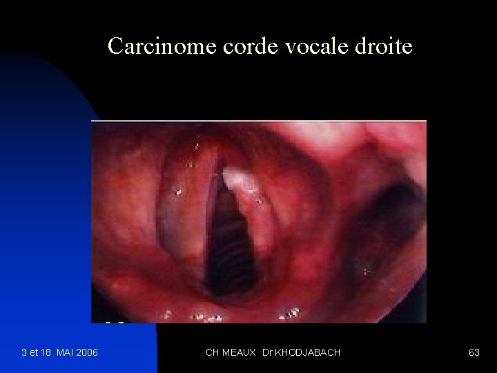 Carcinome corde vocale droite 3 et 18 MAI 2006 CH MEAUX Dr KHODJABACH 63